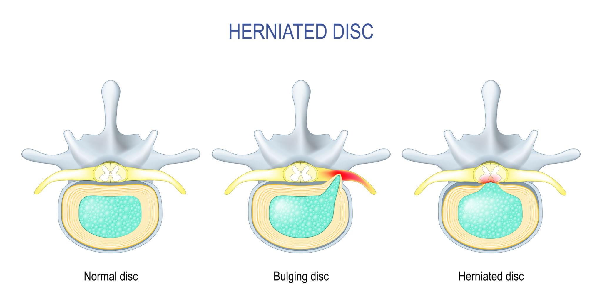 Illustration showing the difference between a herniated disc and a bulging disc in the lumbar spine